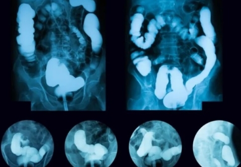 GIST có thể phát hiện thông qua các xét nghiệm hình ảnh nào?